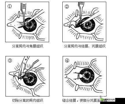 获得超级胬肉系统怎么办:寻求专业帮助