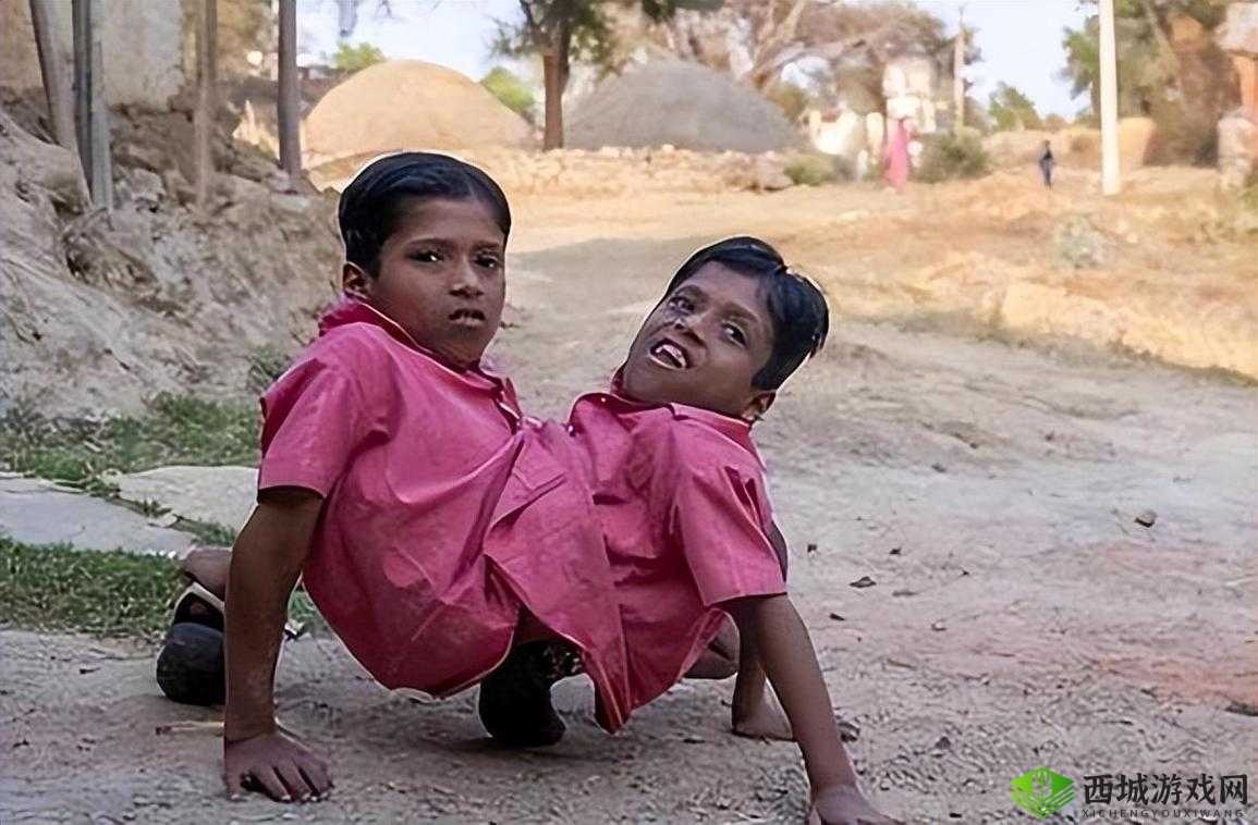 神奇的共生双胞胎:共享身体,共享人生