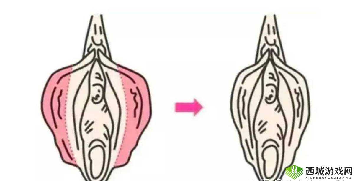 小阴天唇肥大整形有必要吗:专家解析