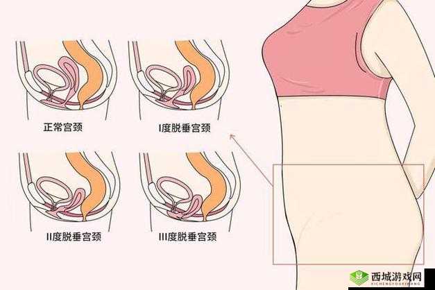 女性得阴挺病是怎么回事:病因与治疗