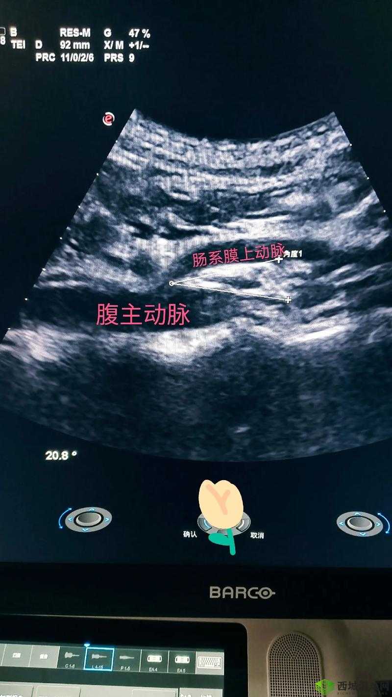 胡桃夹精索静脉曲张能治好吗:如何有效治疗胡桃夹精索静脉曲张