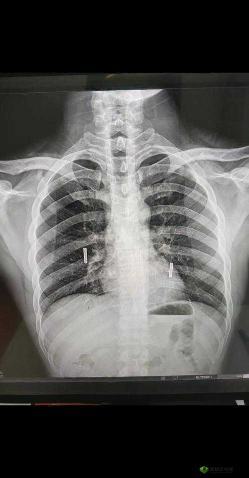 十大曝光胸片，揭示不为人知的真相