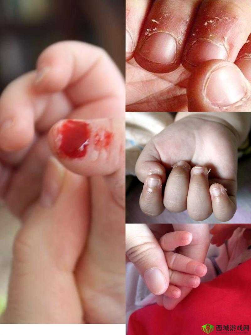 宝宝才三根手指就已疼得不行,妈妈心疼不已