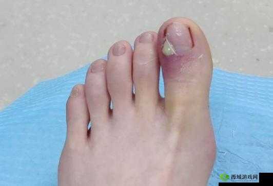 红肿疼痛且小缝无法合拢,这究竟是怎么回事