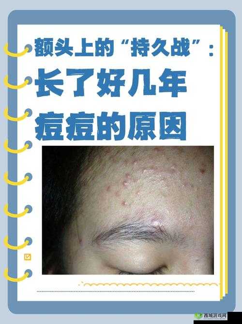 痘痘的烦恼与自我救赎,一场肌肤的战役